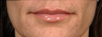 Restylane Lips