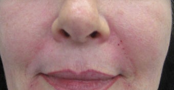 54 year old Female Treatment for Naso-labial fold