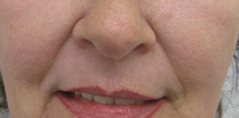 54 year old Female Treatment for Naso-labial fold