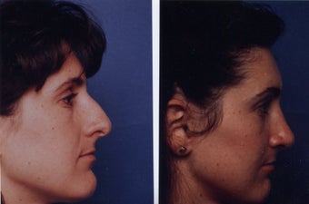 Nose