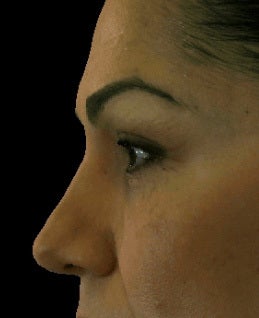 Hyaluronic acid fillers to lower lids and mid face