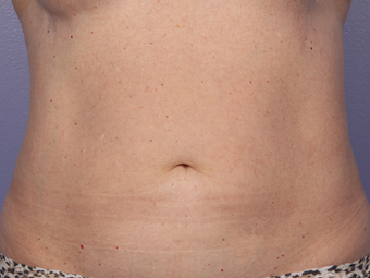 CoolSculpting by Zeltiq to Abdomen