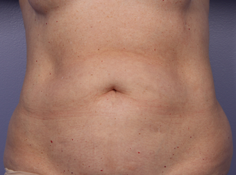 CoolSculpting by Zeltiq to Abdomen