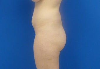 Brazilian Butt Lift