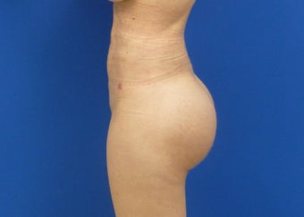 Brazilian Butt Lift