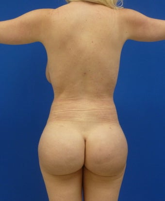 Brazilian Butt Lift