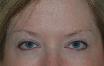 Botox Treatment