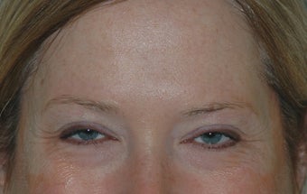 Botox Treatment