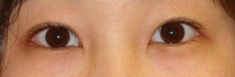 Bilateral Asian Eyelid Surgery
