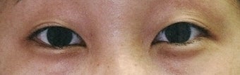 Bilateral Asian Eyelid Surgery
