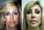 48 year old lady before and after cheek augmentation