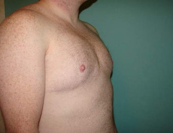 Late results of FTM chest masculinization 