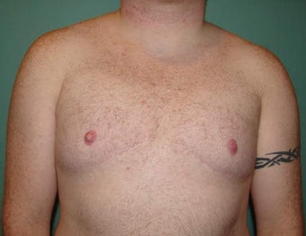 Late results of FTM chest masculinization 