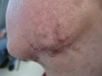 6 year old boy with persistent facial scar