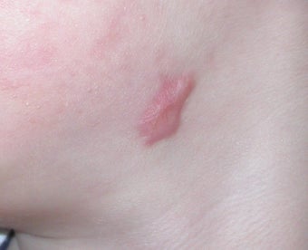 6 year old boy with persistent facial scar