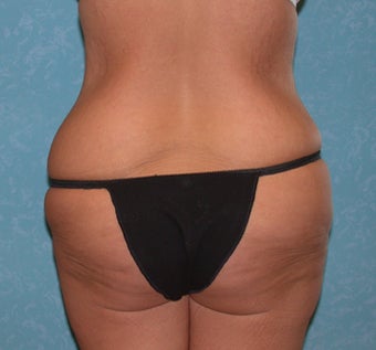 Circumferential Body Lift