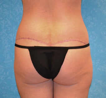 Circumferential Body Lift