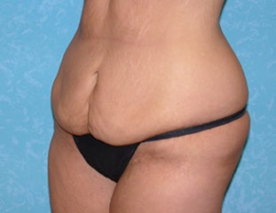 Circumferential Body Lift