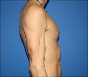 Pectoral Augmentation, Pec Implants