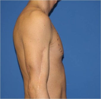 Pectoral Augmentation, Pec Implants