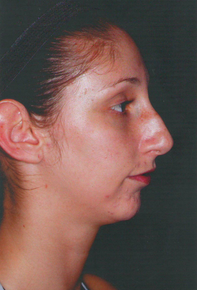 Septorhinoplasty