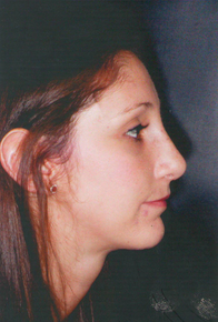 Septorhinoplasty