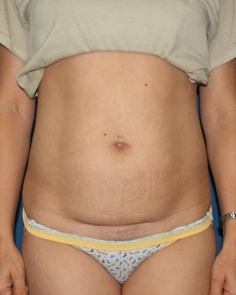 Vaser Liposuction of the Abdomen