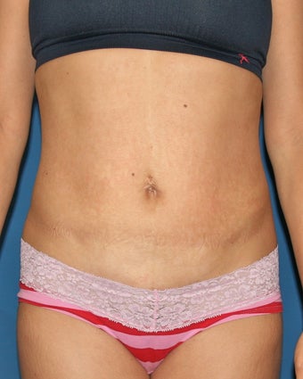 Vaser Liposuction of the Abdomen