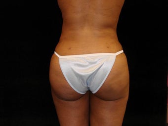 Buttocks Augmentation by Fat Grafting