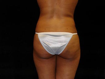 Buttocks Augmentation by Fat Grafting