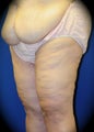 Thigh Lift