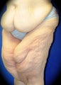 Thigh Lift
