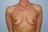 Breast Augmentation