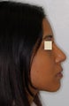 Rhinoplasty