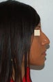 Rhinoplasty