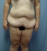 45 year old Tummy tuck after weight loss 65#
