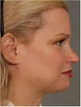 41 year old female with early jowls and neck laxity with excess volume.  She doesn't want invasive surgery.
