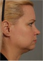 41 year old female with early jowls and neck laxity with excess volume.  She doesn't want invasive surgery.