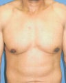 Male Breast Reduction