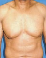 Male Breast Reduction
