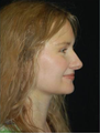 Brow Lift with Liposuction of the Neck