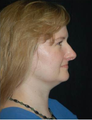 Brow Lift with Liposuction of the Neck