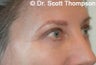 Brow Lift/Forhead Lift