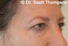 Brow Lift/Forhead Lift