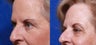 Before and after one treatment of Total FX