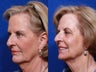 Before and after one treatment of Total FX