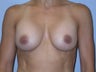 Breast Augmentation