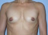 Breast Augmentation