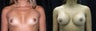 Breast Augmentation