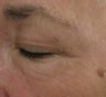 Crows feet and eye wrinkles treated with 1 treatment of Lux 1540 Fractional Laser